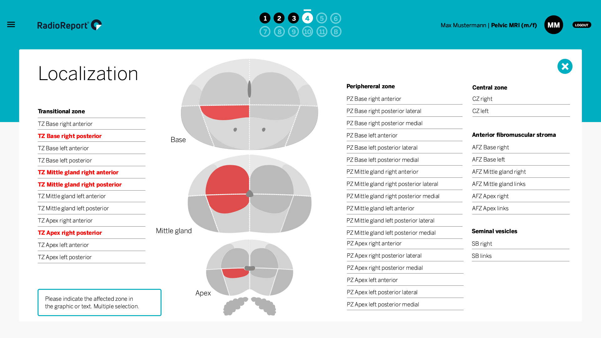 RadioReport MRI Pelvis Localization Prostate